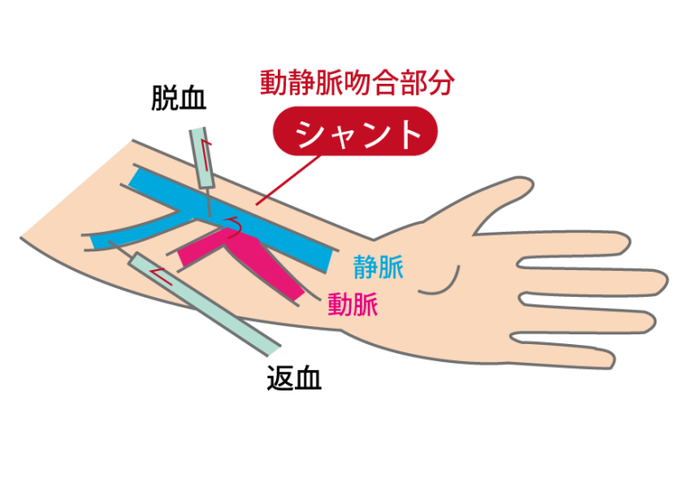  内シャント造設 